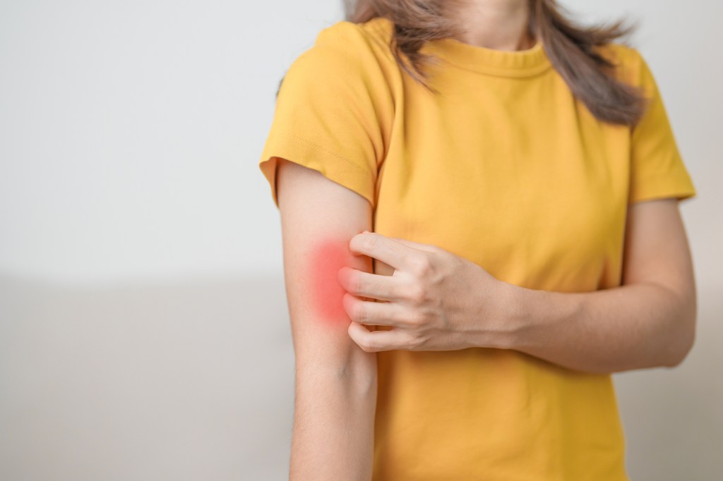 Lupus is sometimes called a cruel mystery as it may take many years for patients to be accurately diagnosed. A rash is a main key. Here, a woman scratches a rash.